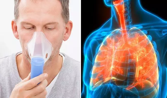 क्या है सिस्टिक फाइब्रोसिस और कैसे पाएं इससे छुटकारा क्या है सिस्टिक फाइब्रोसिस और कैसे पाएं इससे छुटकारा